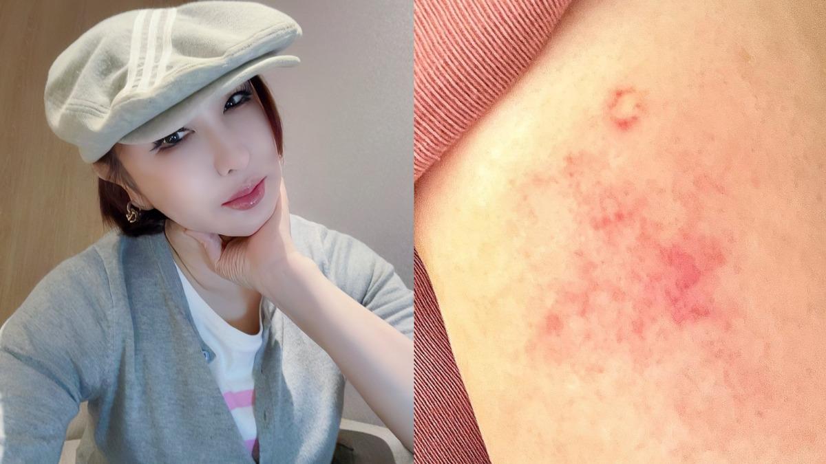 利菁出事了！搭Uber「手臂被電」遭蜜蜂螫傷　拔毒針哭訴：沒責任嗎