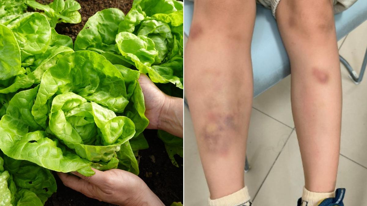 中國一名男童因為食用生菜，竟感染寄生蟲。（示意圖／達志影像shutterstock、翻攝自羊城晚報）
