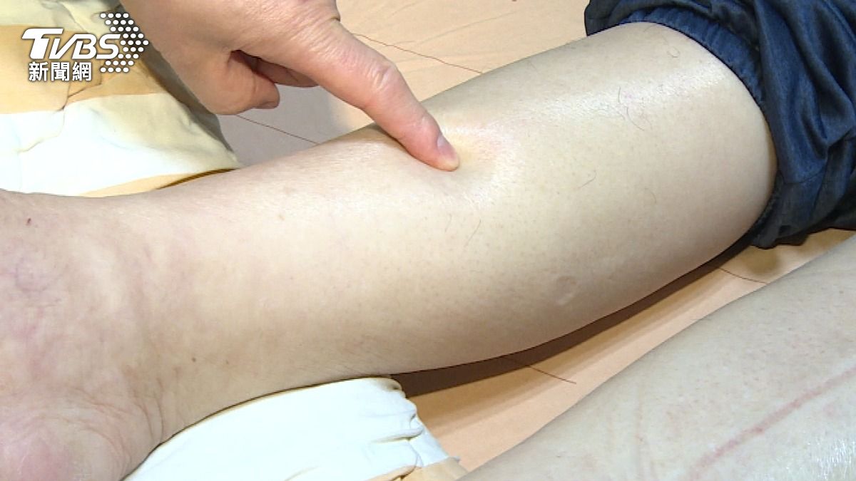水腫不是變胖！醫揭心.肝.腎警訊　出現「這症狀」勿輕忽 (圖/TVBS)