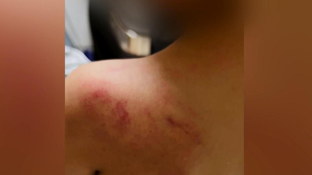 高雄市三民區一名5歲女童遭老師重打左肩,造成大片紅腫瘀青,家長發現後憤而驗傷提告。(圖/當事人提供)