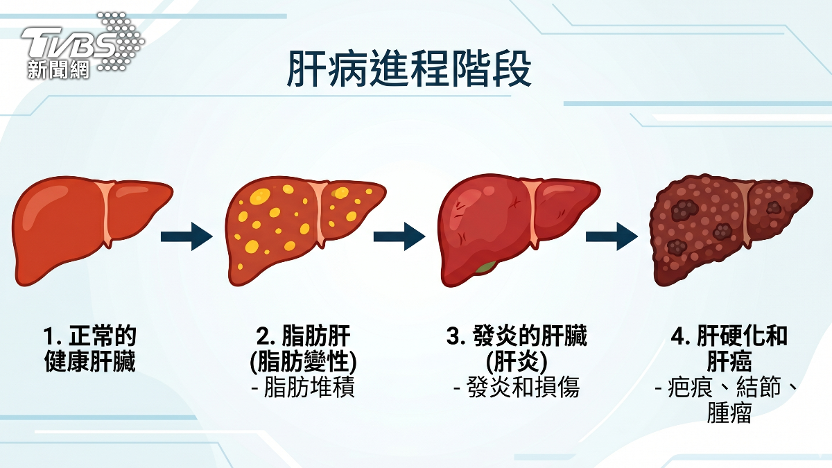 脂肪肝初期沒症狀!健檢才發現 醫曝5大高風險族群 (圖/TVBS)