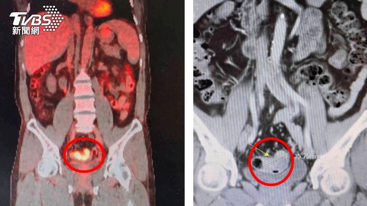 身體超健康卻罹癌!51歲男糞便潛血陽性 一照大腸鏡竟是癌症