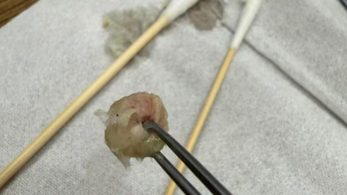 習慣塞衛生紙止鼻水！6歲童鼻塞流血　醫夾出「整坨異物」驚呆家長