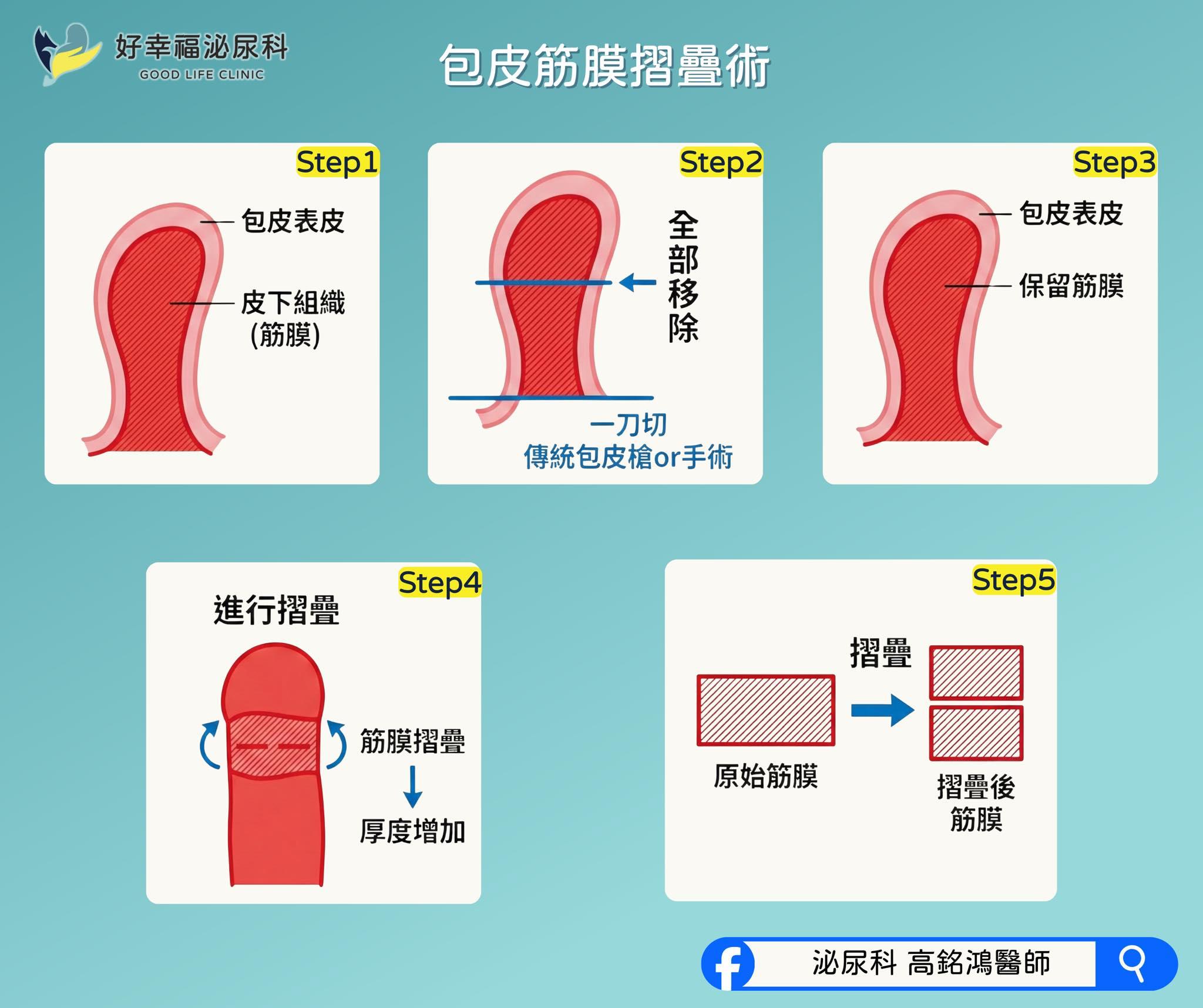 筋膜折疊術的手術過程示意圖。（圖／翻攝自臉書「泌尿科高銘鴻醫師」）　