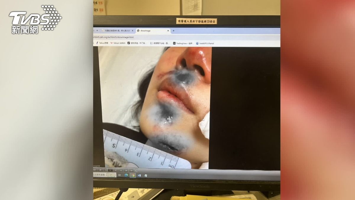 21歲女演員指控，去年11月因為車禍縫了11針、斷兩顆牙，但至今已經過了半年，仍拿不到任何的保險理賠。（圖／當事人提供）