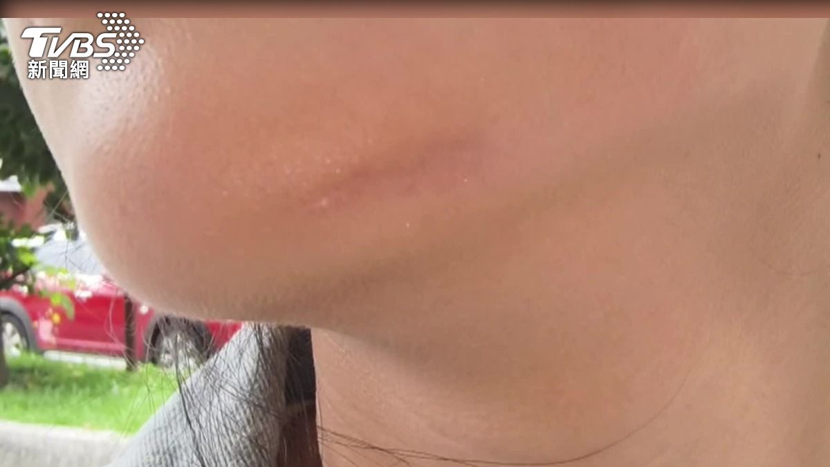 車禍後經過治療跟除疤，但下巴仍有３公分的疤痕，光靠一般化妝很難遮蓋。（圖／TVBS）
