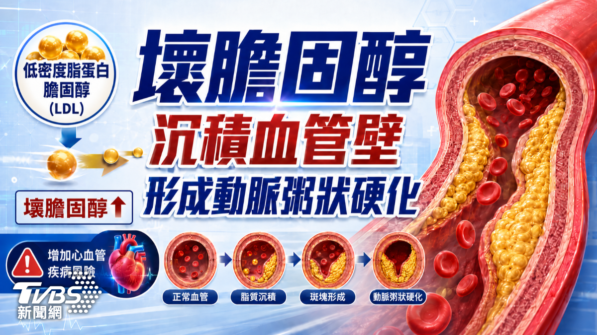 高血脂沒症狀卻傷血管！醫揭「這數值」太高　恐釀心肌梗塞、中風 (圖/TVBS)