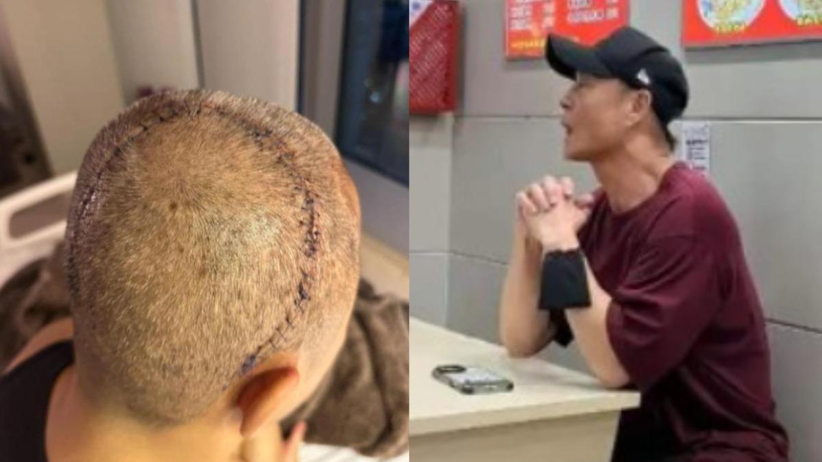 草蜢蔡一傑癌細胞擴散!切除腦部7公分腫瘤 暴瘦近況曝