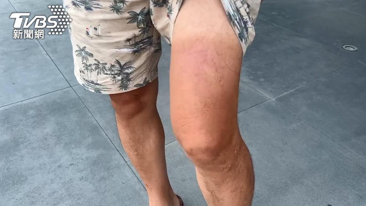小孩曬傷紅腫脫皮別大意!醫曝成年後皮膚癌風險「超過8倍」