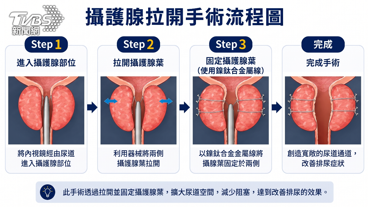 攝護腺肥大不只吃藥!微創拉提治療改善排尿困難 (圖/TVBS)
