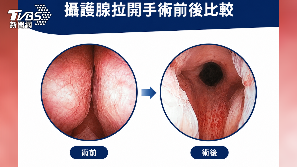 攝護腺肥大不只吃藥!微創拉提治療改善排尿困難 (圖/TVBS)