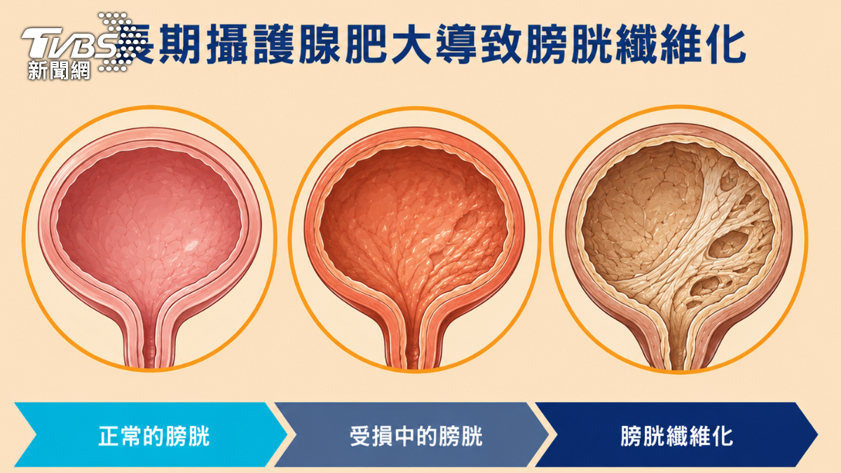 攝護腺肥大不只吃藥!微創拉提治療改善排尿困難 (圖/TVBS)