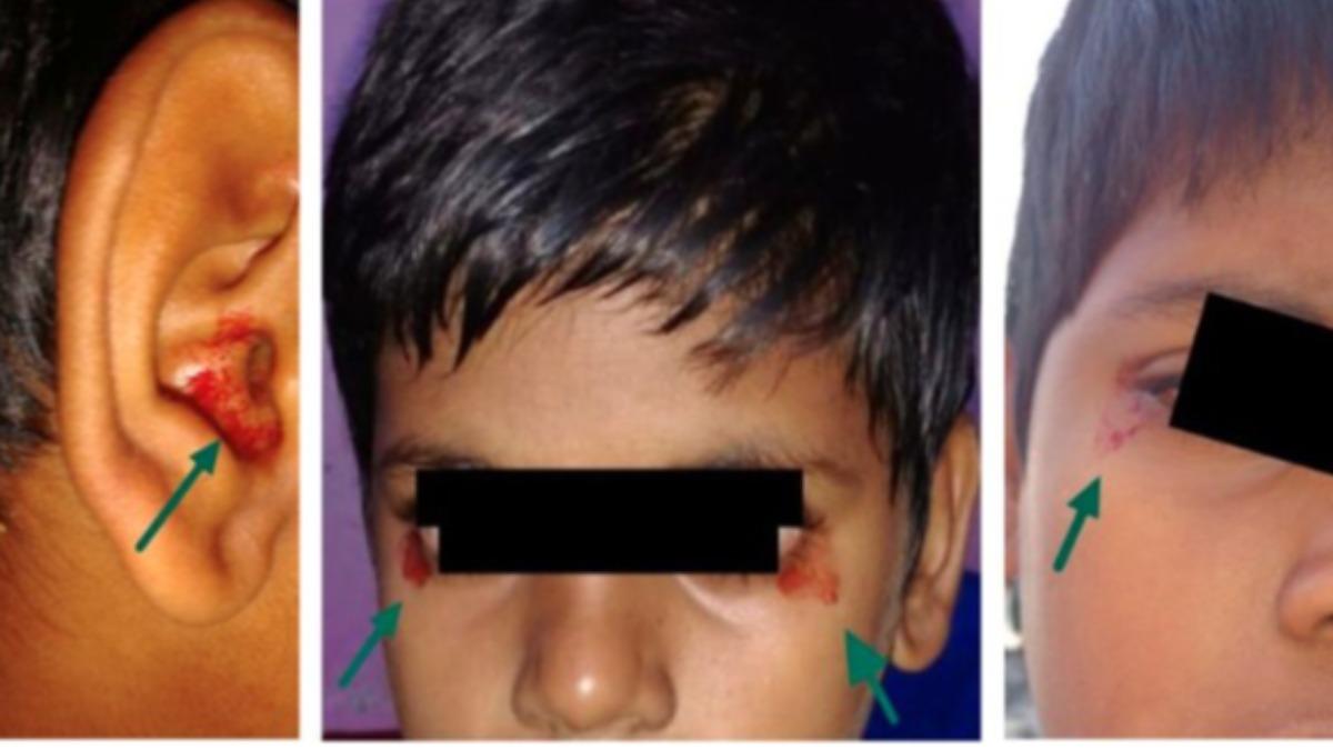 壓力太大?11歲印男童突「眼鼻耳流血」 全球不到50例怪病曝