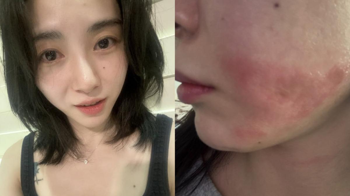 珉娥醫美二度燒傷毀容！工作停擺損失1億　遭院方反控「恐嚇罪」