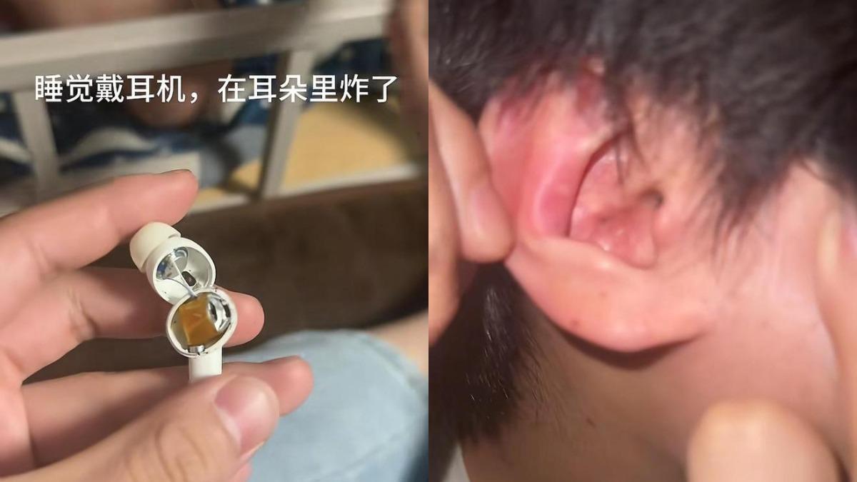 深夜藍芽耳機突「耳內爆炸」!陸男大生曝非雜牌:銷量達百萬副
