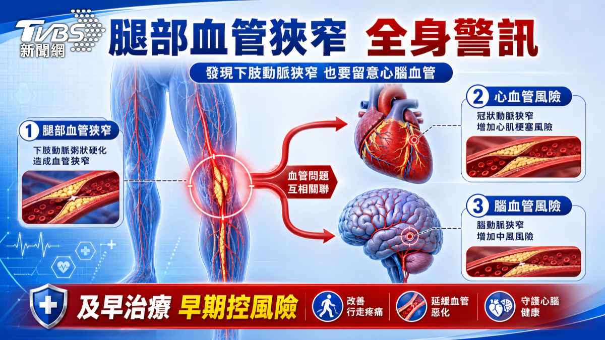 走路小腿痠痛別輕忽！醫示警出現「這狀況」恐心梗．中風前兆　(圖／TVBS)