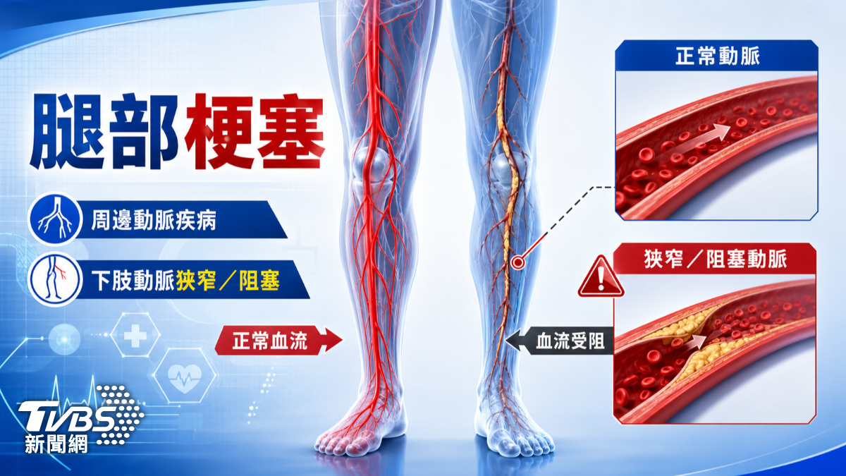 走路小腿痠痛別輕忽！醫示警出現「這狀況」恐心梗．中風前兆　(圖／TVBS)