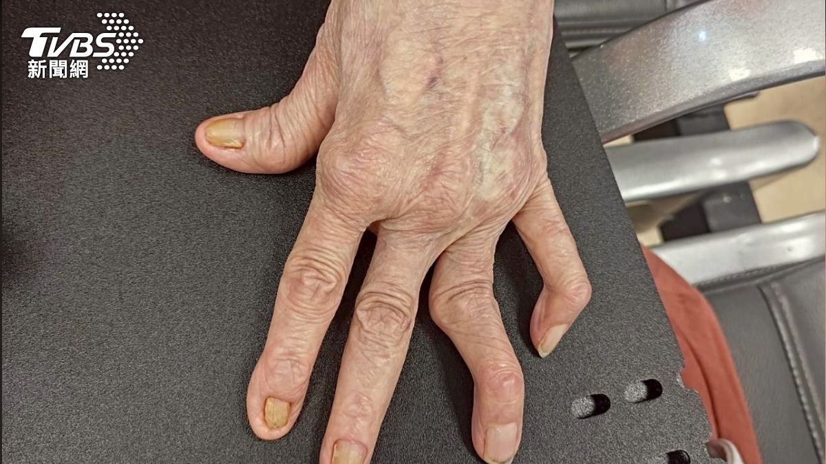 告別關節痛與變形:若不懂「這件事」小心!類風濕性關節炎找上門 (圖/TVBS)