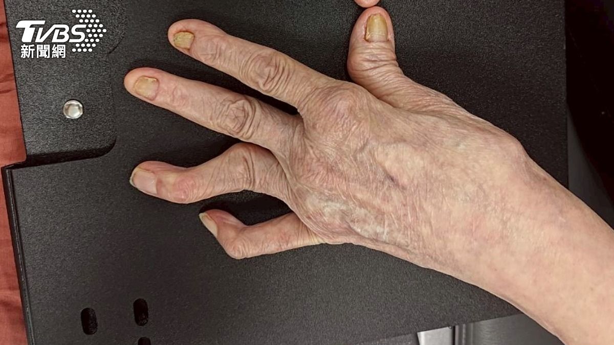 告別關節痛與變形:若不懂「這件事」小心!類風濕性關節炎找上門 (圖/TVBS)