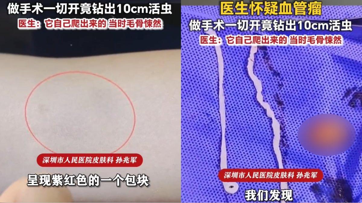 本以為是腫瘤!陸女左手臂長腫塊 切開竟鑽出2條「白色活蟲」