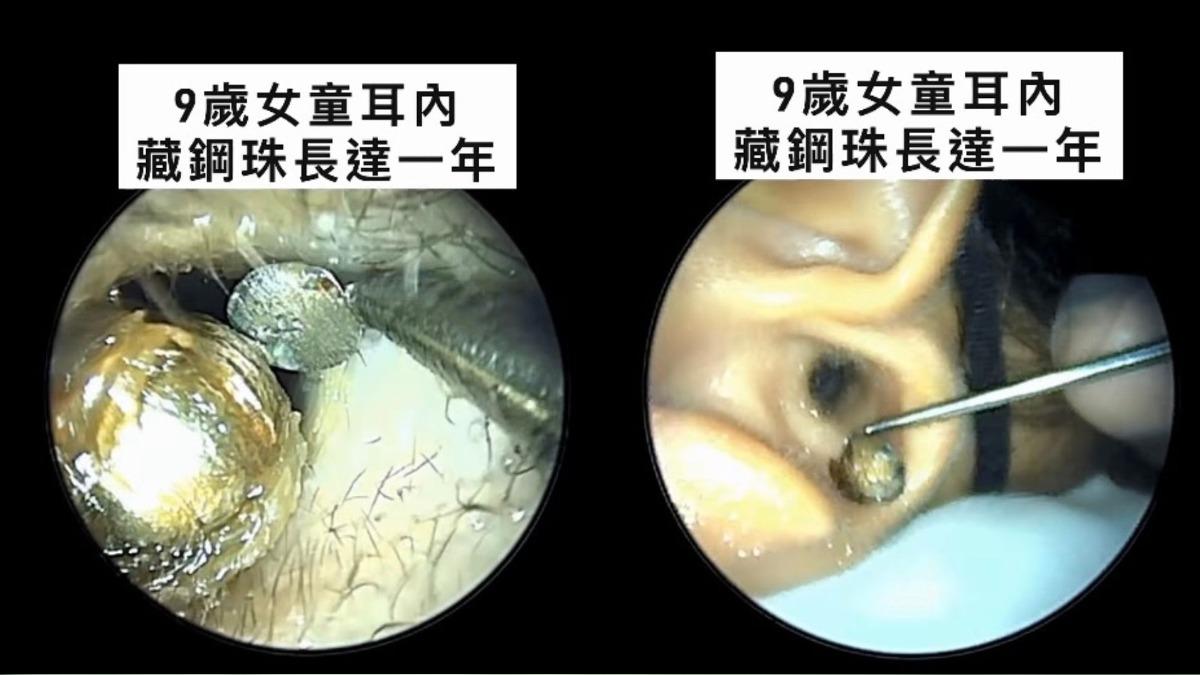 9歲女童耳朵挖出「亮透鋼珠」卡一年 醫驚:毛骨悚然