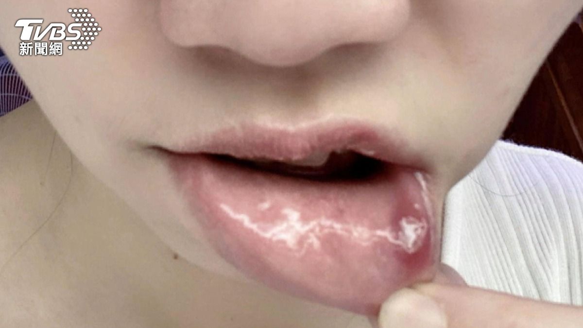 反覆嘴破不是火氣大?醫師警告超過兩週沒好 快就醫