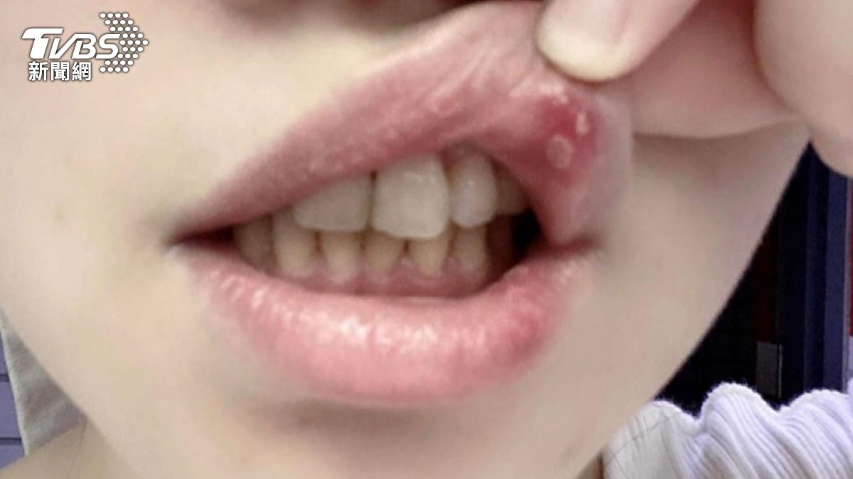 反覆嘴破不是火氣大？醫師警告超過兩週沒好　快就醫 (圖/TVBS)