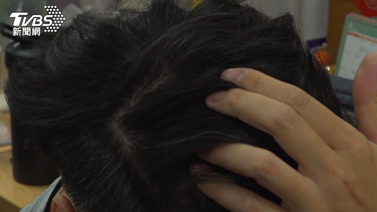 夏天防曬別漏頭皮!經常「做這件事」長期曝曬 恐曬傷、局部落髮 (圖/TVBS)