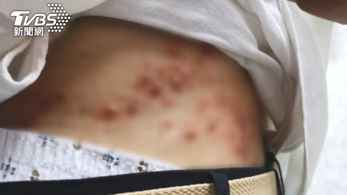 腎臟病患感染皮蛇風險爆增29% 嚴重恐失明