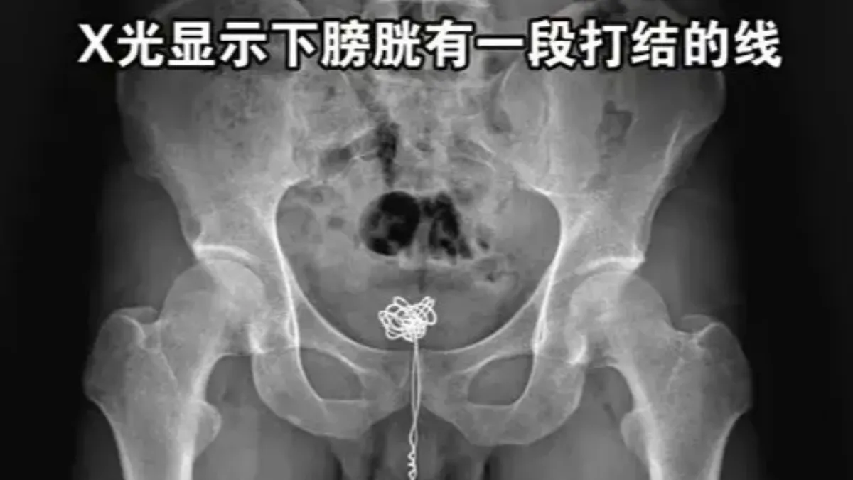 只因好奇!陸男「25公分傳輸線」塞尿道 撐12小時出血才就醫