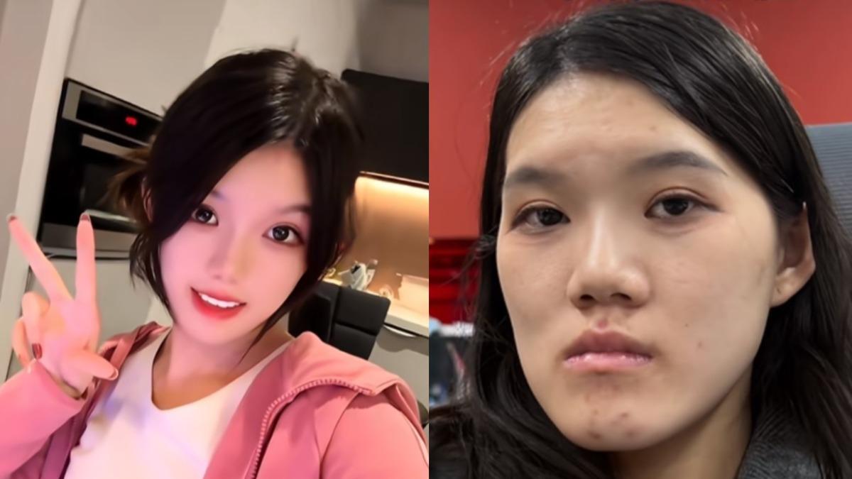 正顎失敗「撞臉朱元璋」!24歲陸正妹崩潰 醫:這樣很洋氣