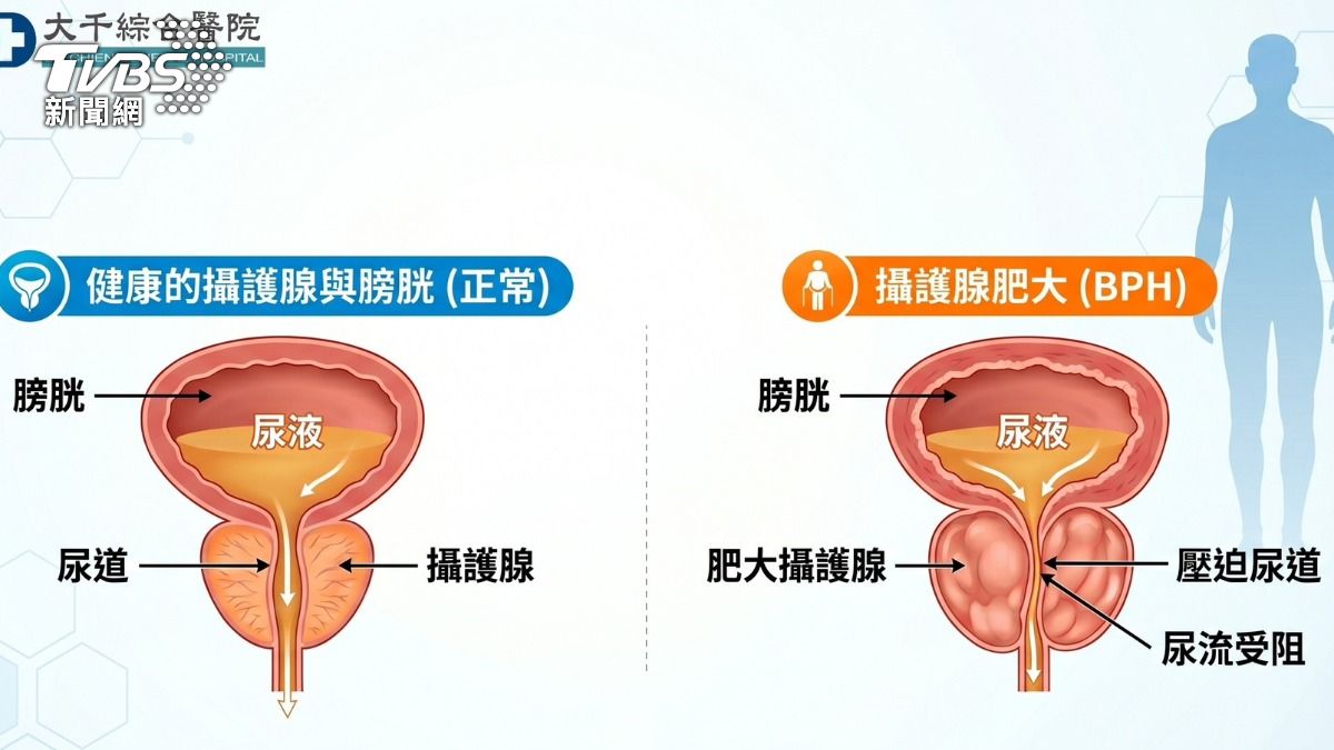 攝護腺肥大和正常比較。(圖/TVBS)
