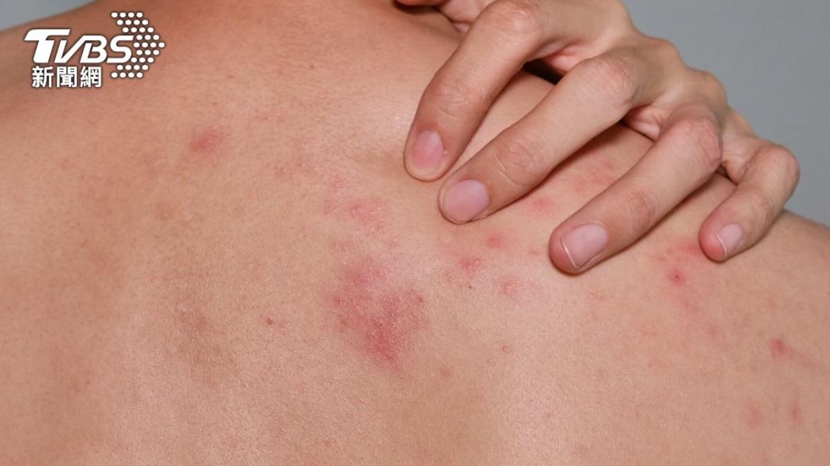 7旬婦肚子整片紅疹竟不痛不癢 醫檢查心涼了:乳癌轉移了