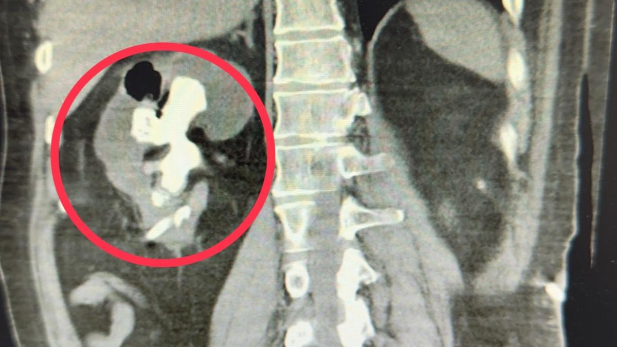 發燒誤認流感!5旬男休克險死 醫驚:巨型「鹿角狀結石」塞爆右腎