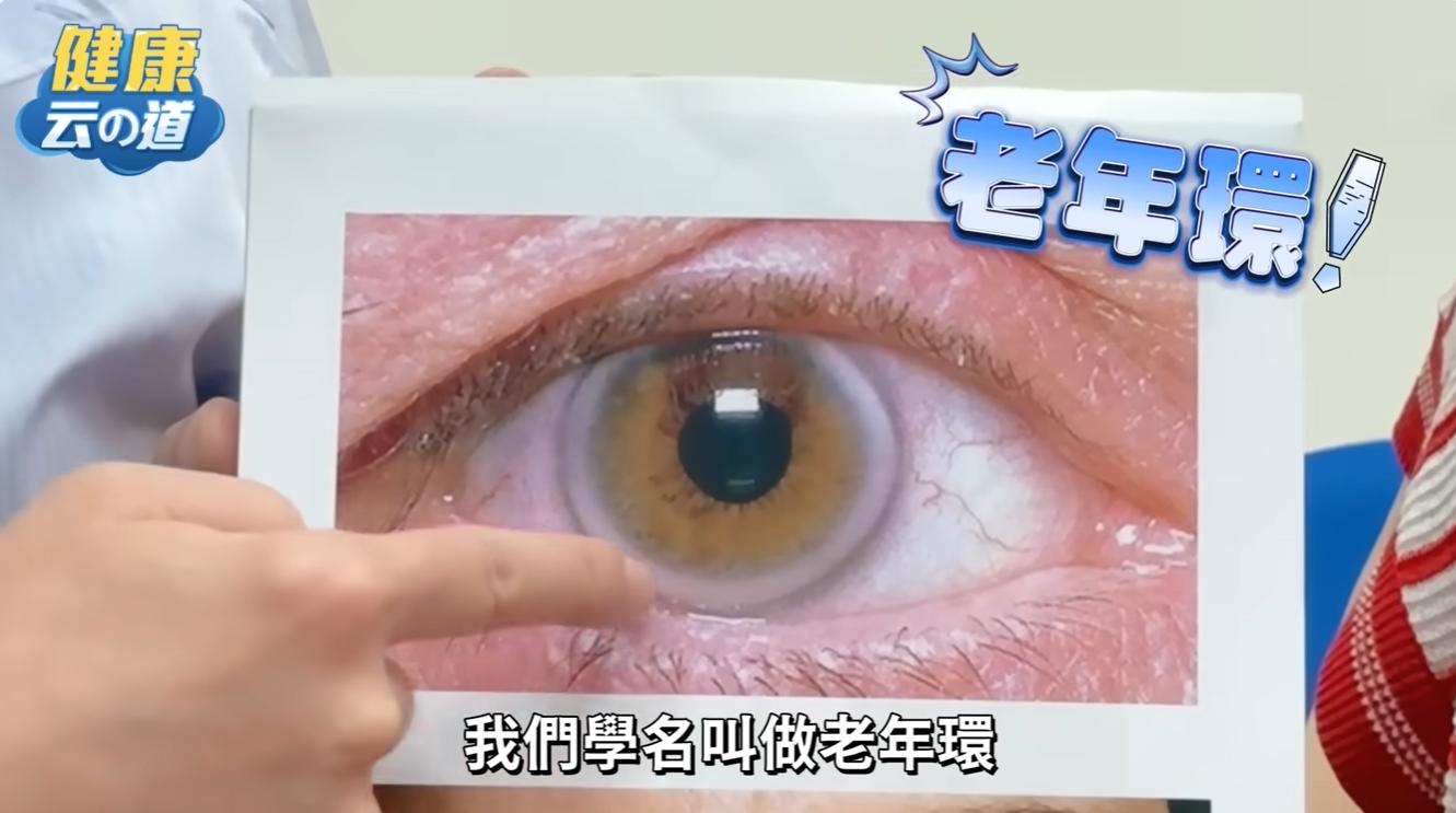 高血脂引發眼睛加速老化,眼球外圍出現一圈白。(圖/翻攝自YouTube@健康主播鄭凱云)