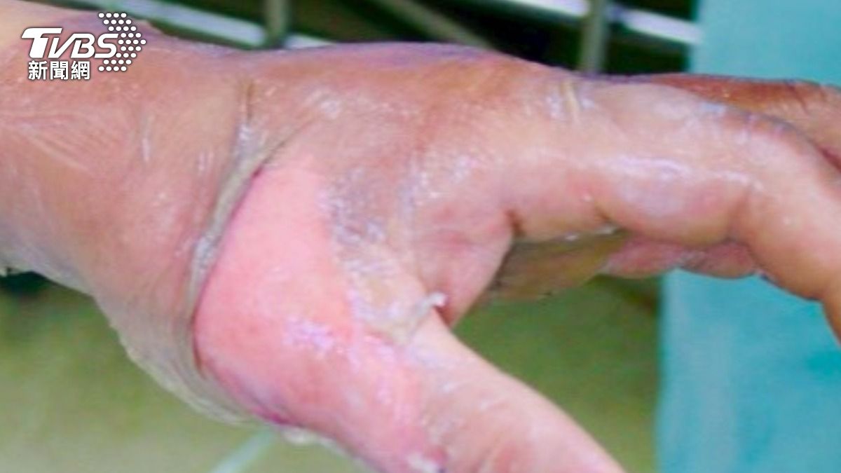 腳底水泡走路痛怎麼辦?醫揭刺破前後 處理重點!(圖/TVBS)