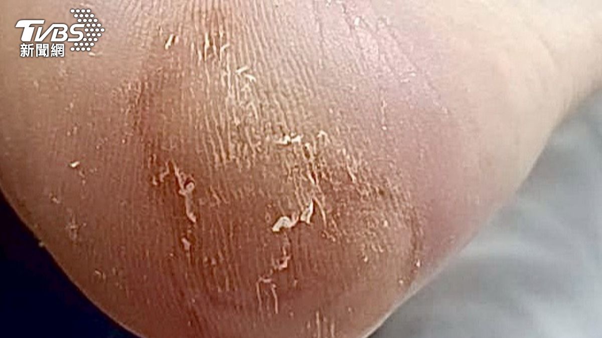 腳底水泡走路痛怎麼辦?醫揭刺破前後 處理重點!(圖/TVBS)
