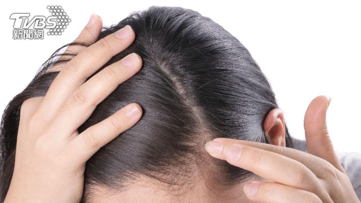 女童頭皮癢、頭髮冒白點!醫驚覺「感染頭蝨」:初期症狀不明顯