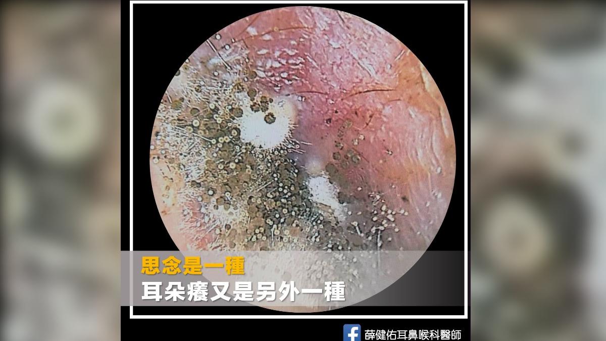 不是有人想你!男耳癢「長滿菌絲、孢子囊」 醫:完整黴菌生態系