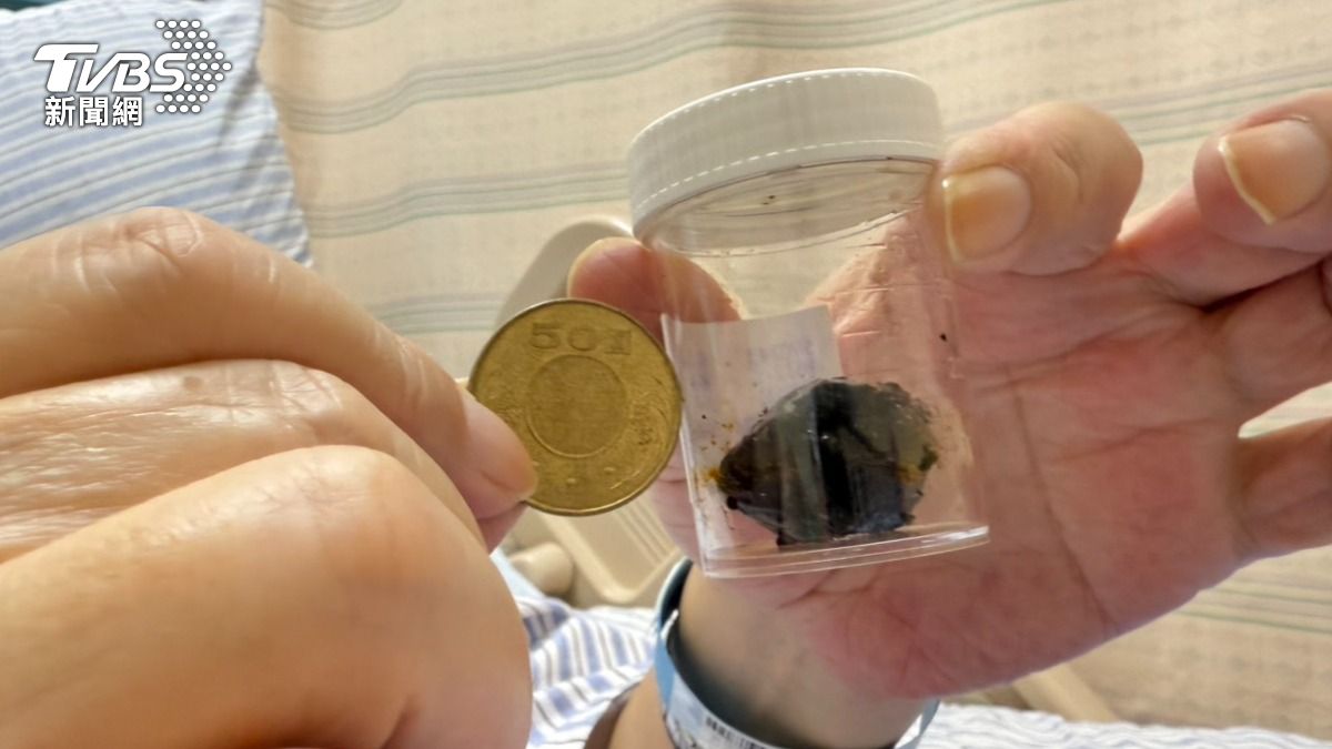 狂嗑炸雞隔天劇痛送醫!長50元硬幣大膽結石 男敗血症險喪命