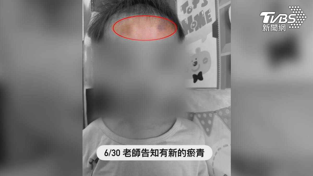 屏東一名2歲大男童,今年3月送托居家保母,身上卻陸續有瘀傷,家長驗傷、報警提告(圖/TVBS)