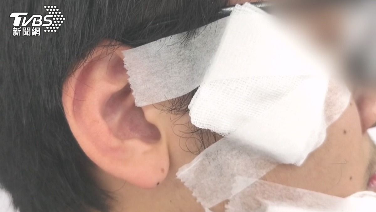 20歲年輕人被流浪狗群追摔傷，怒控「愛爸愛媽」餵食惹禍。（圖／TVBS）