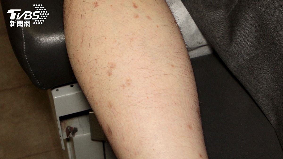 5旬男腿冒怪圈20年!醫曝「這習慣」惹禍:恐有癌變風險