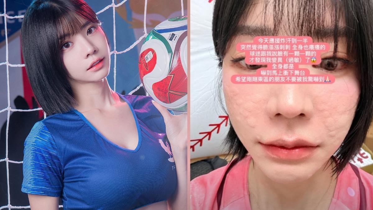 林艾融臉突然出現過敏反應。（圖／翻攝自IG）