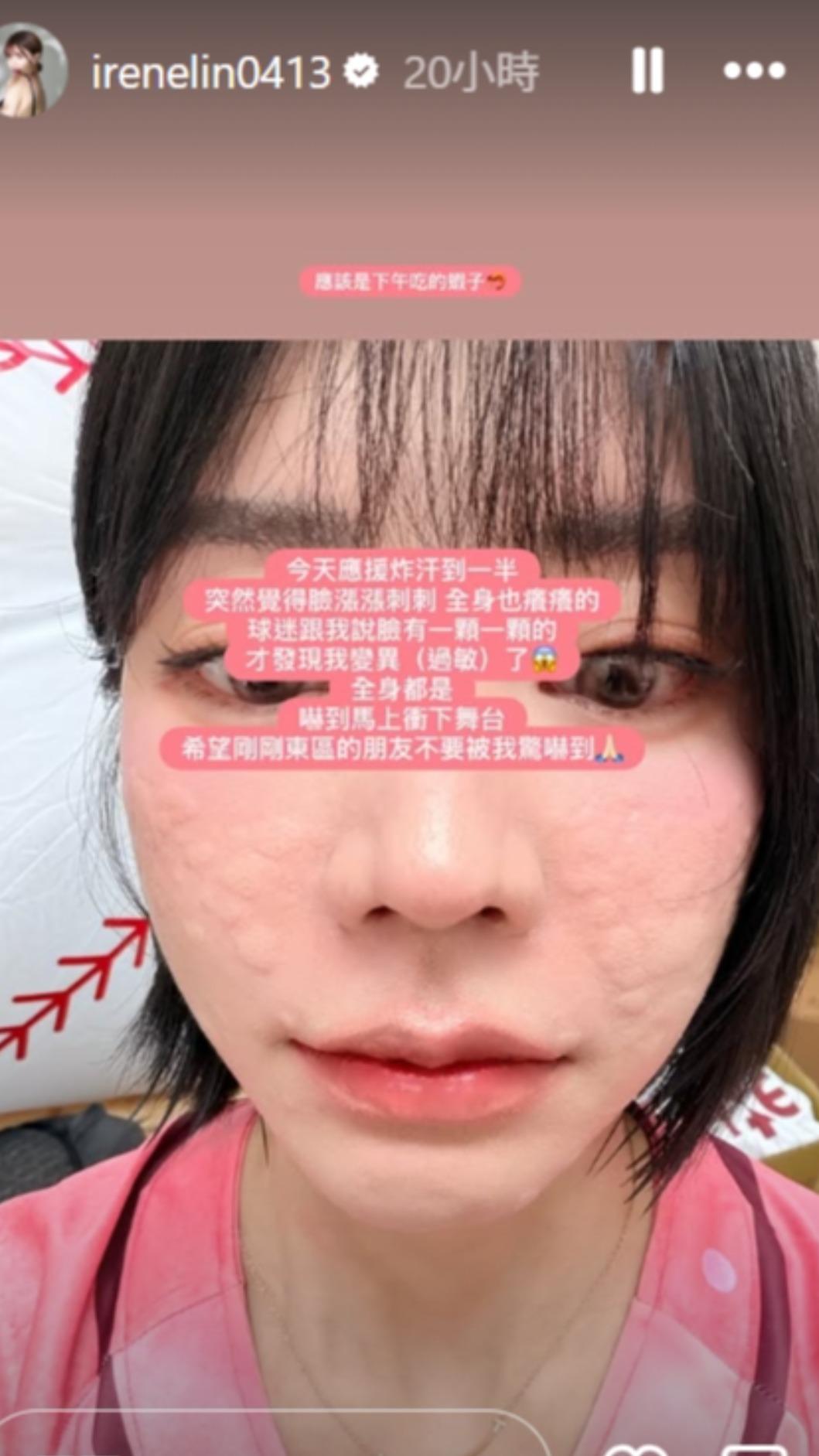 林艾融臉長滿顆粒。(圖/翻攝自IG)