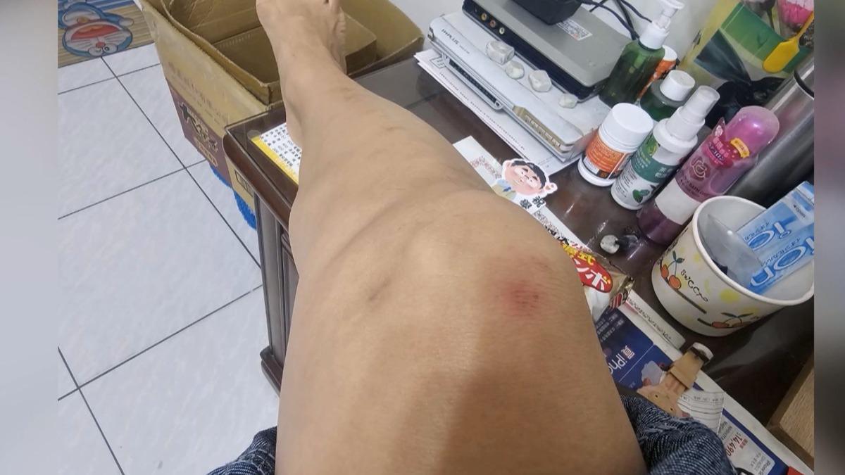 高雄一名林姓女子去年陪孩子到路竹一間診所就醫，離開時在門口水泥斜坡踩空，導致四肢受傷。（圖／當事人提供）