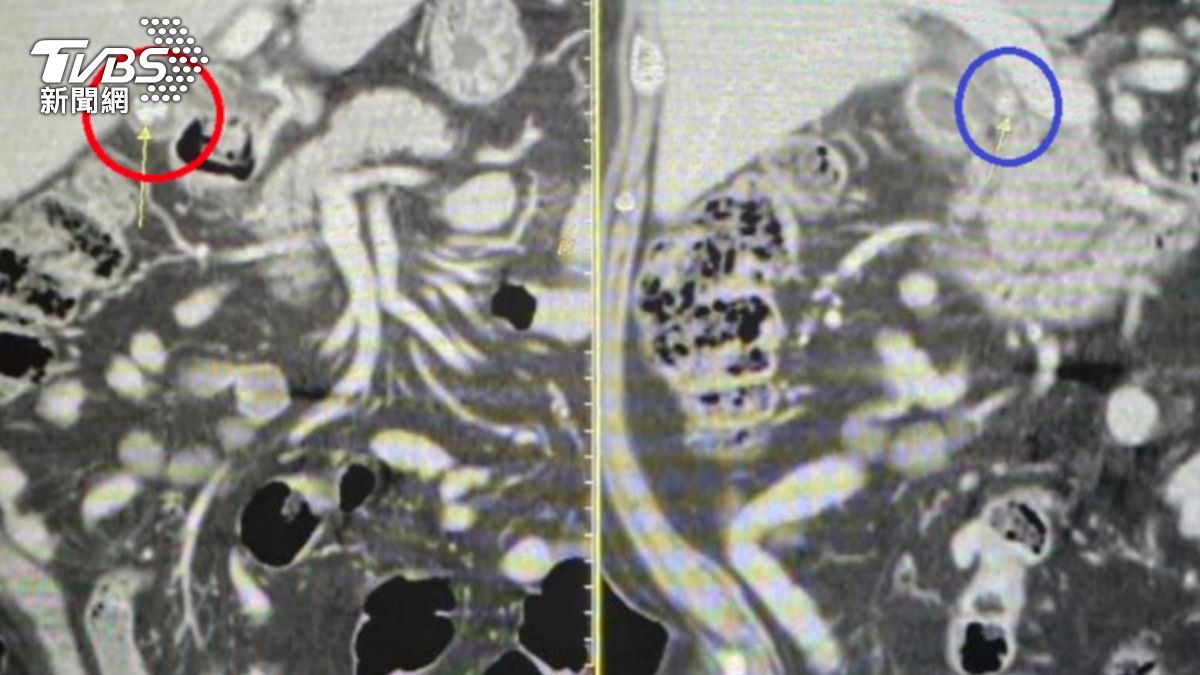 腹痛別當胃痛!48歲科技男一拖再拖 膽管全塞險敗血症喪命