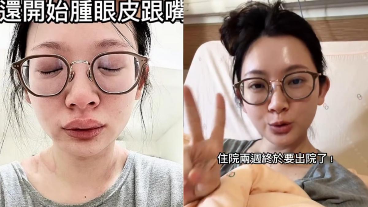 優格姐姐蕁麻疹發作瀕死。(圖/翻攝自IG)