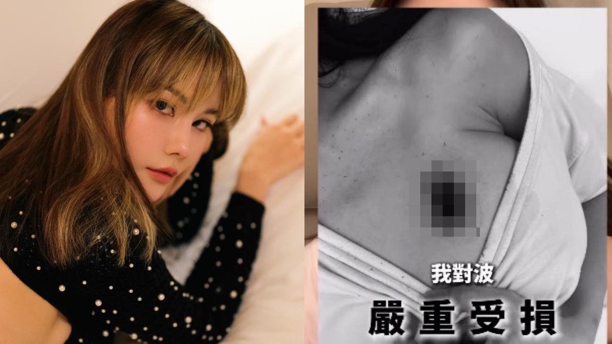 吞安眠藥出事！五索自曝「胸部重傷」痛心：最值錢的部位