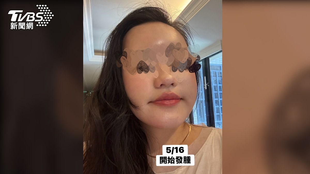 施打完膠原蛋白增生劑之後,開始出現發炎、腫的狀況。(圖/當事民眾提供)